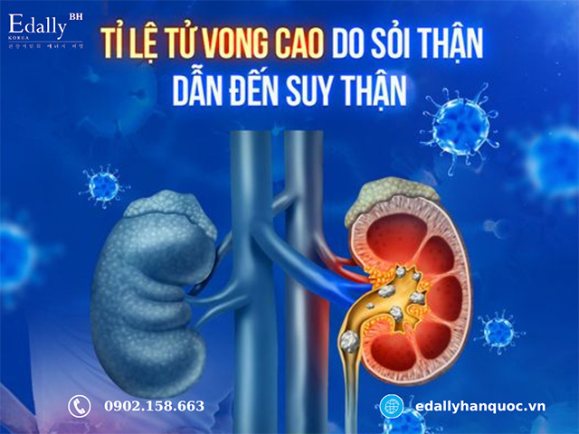 Tỉ lệ tử vong cao do sỏi thận dẫn đến suy thận