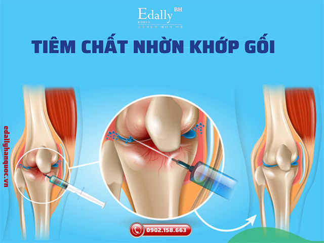 Tiêm chất nhờn vào khớp gối có tốt không?