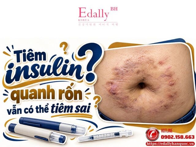 Tiêm insulin “vòng quanh rốn”: một lời dặn chưa đầy đủ có thể khiến người bệnh tiêm sai kéo dài Tiêm insulin “vòng quanh rốn”: một lời dặn chưa đầy đủ có thể khiến người bệnh tiêm sai kéo dài