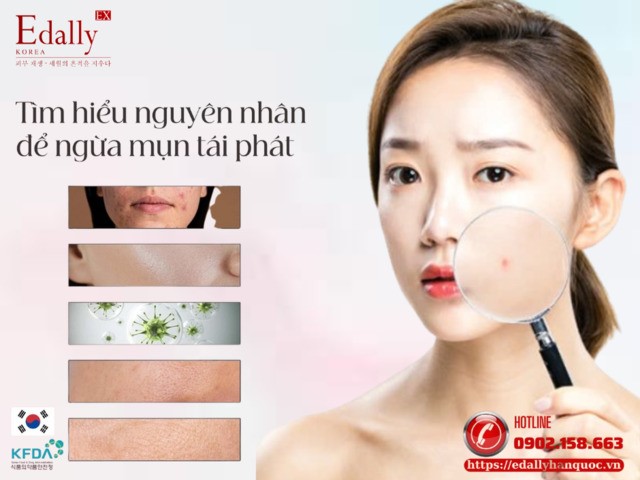 Khi da bị mụn cần xác định nguyên nhân để ngừa mụn tái phát