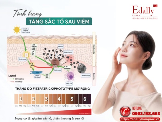 Tình trạng tăng sắc tố sau viêm (PIH)