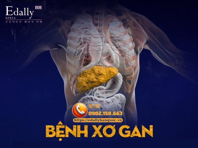 Tổng quan về bệnh xơ gan