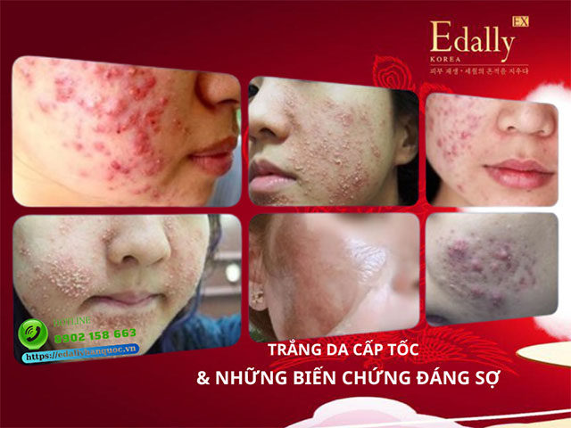 Trắng da cấp tốc và những biến chứng đáng sợ