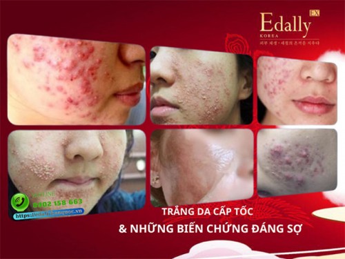 Làm Trắng Da Cấp Tốc Và Những Biến Chứng Đáng Sợ