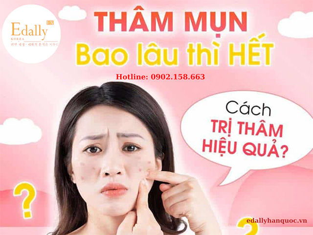 Da bị mụn và thâm mụn thì phải làm sao?