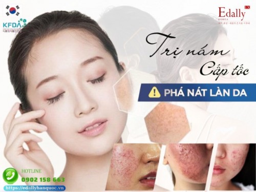 Những Nguy Hại Khi Cố Tìm Cách Điều Trị Nám Da Cấp Tốc