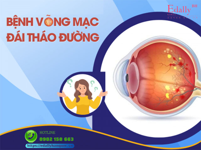 Triệu chứng bệnh võng mạc tiểu đường