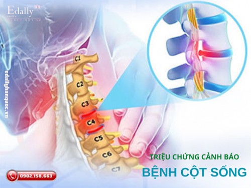 Triệu Chứng Cảnh Báo Nguy Cơ Mắc Bệnh Thoái Hóa Cột Sống