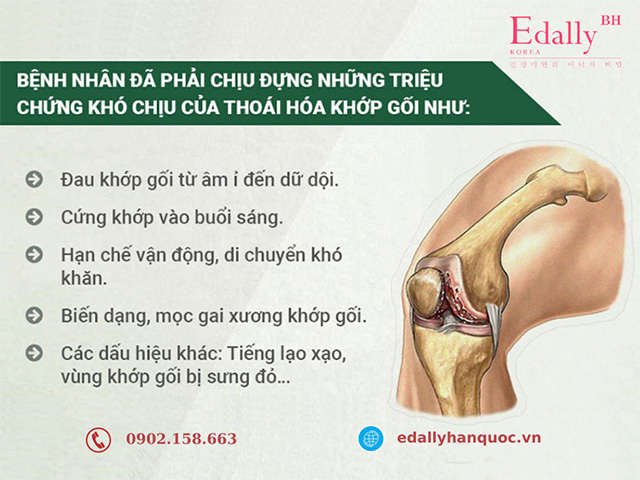 Dấu hiệu nhận biết bệnh thoái hóa khớp gối