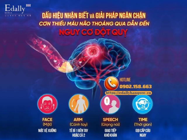 Dấu hiệu nhận biết cơn thiếu máu não cục bộ thoáng qua (TIA) có thể dẫn đến đột quỵ