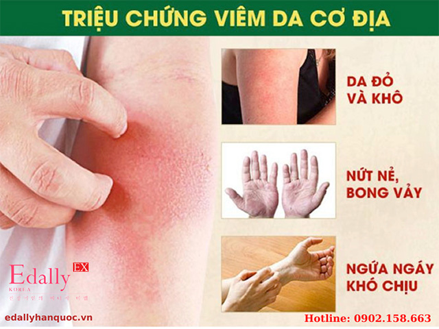 Triệu chứng của bệnh viêm da cơ địa