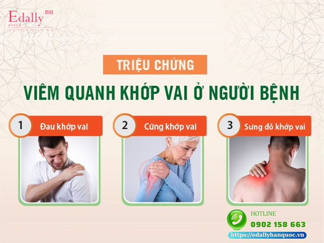 Triệu chứng viêm quanh khớp vai