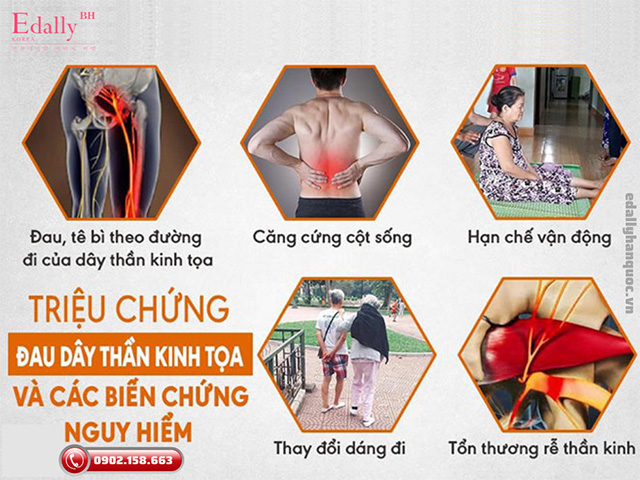 Triệu chứng của đau dây thần kinh tọa và các biến chứng nguy hiểm từ đau thần kinh tọa