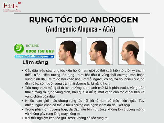 Triệu chứng lâm sàng của rụng tóc hói đầu do Androgen