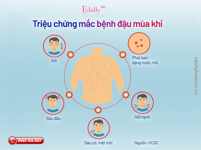 Triệu chứng mắc bệnh đậu mùa khỉ