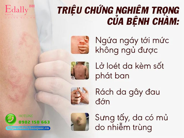 Triệu chứng nghiêm trọng của bệnh chàm