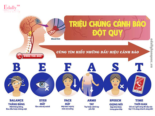 Triệu chứng sớm cảnh báo cơn đột quỵ não xảy ra