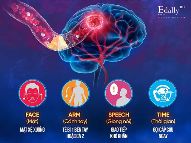 Triệu chứng bệnh tai biến mạch máu não (đột quỵ)