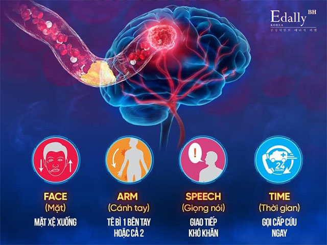 Triệu Chứng Bệnh Tai Biến Mạch Máu Não Và Cách Xử Lý