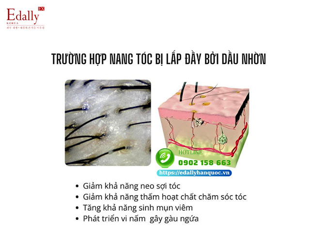 Trường hợp nang tóc bị lấp đầy bởi bã nhờn khi không gội đầu