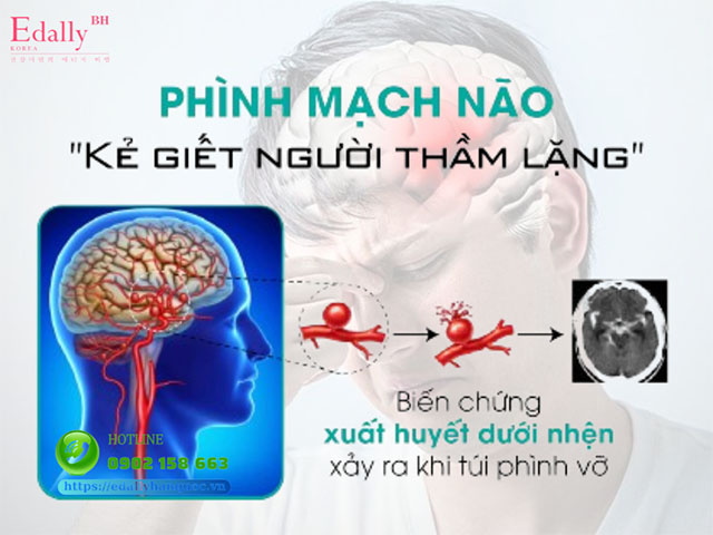 Túi Phình Mạch Máu Não - Những Điểu Cần Biết Về Quả Bom Nổ Chậm Không Hiếm Gặp