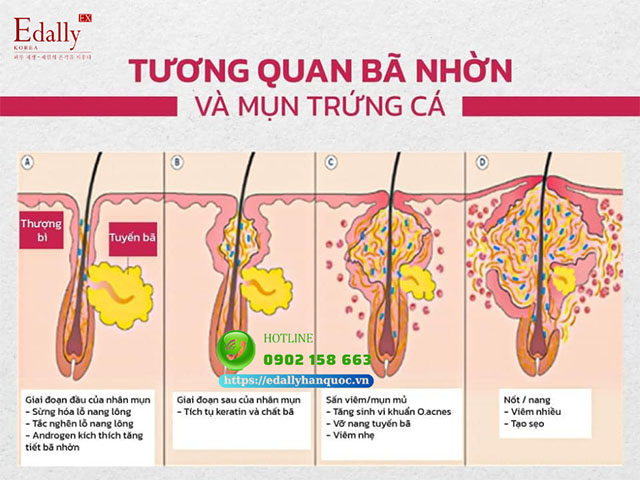 Mối tương quan giữa bã nhờn và mụn trứng cá