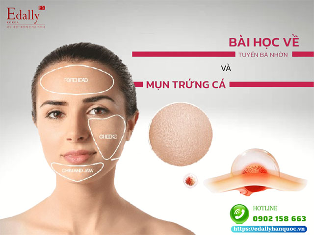 Tuyến Bã Nhờn Và Mụn Trứng Cá