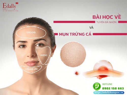 Tuyến Bã Nhờn Và Mụn Trứng Cá