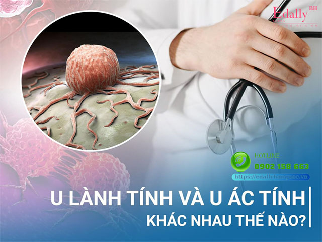 Khối u lành tính và u ác tính khác nhau như thế nào?