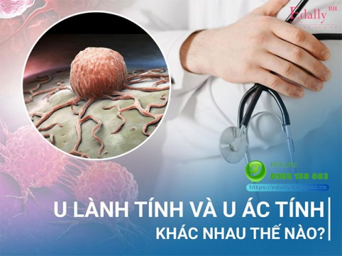 U Lành Tính Và U Ác Tính Khác Nhau Như Thế Nào?