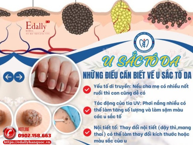 Những điều bạn cần biết về u sắc tố da