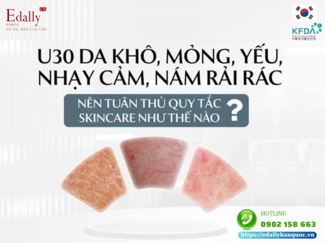 U30 da khô, mỏng yếu, nhạy cảm, nám rải rác nên tuân thủ quy tắc skincare như thế nào?