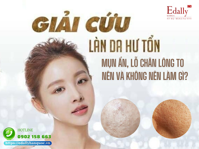 Nên và không nên làm gì khi bị mụn ẩn, lỗ chân lông to?