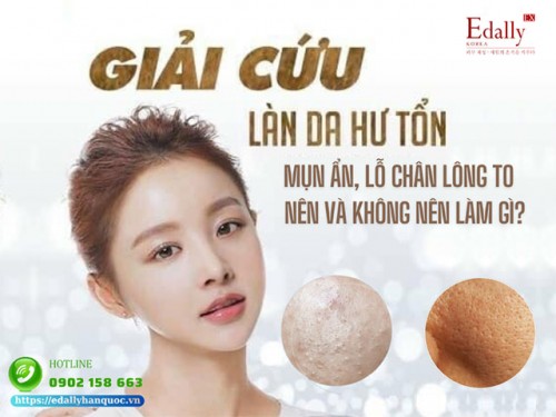 Mụn Ẩn Và Lỗ Chân Lông To Nên Làm Gì Và Không Nên Làm Gì?