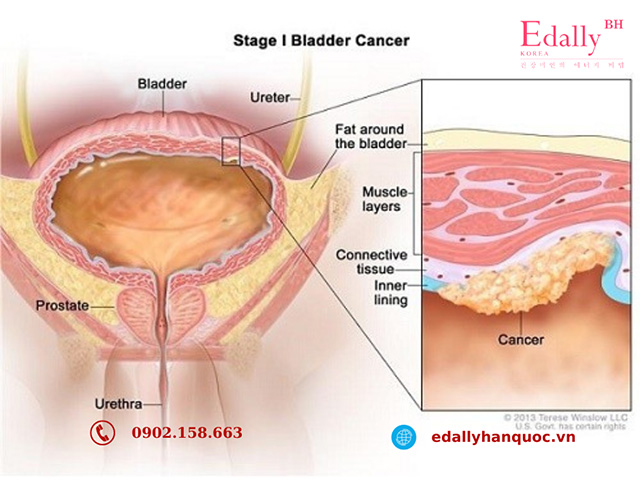 Bệnh ung thư bàng quang giai đoạn 1