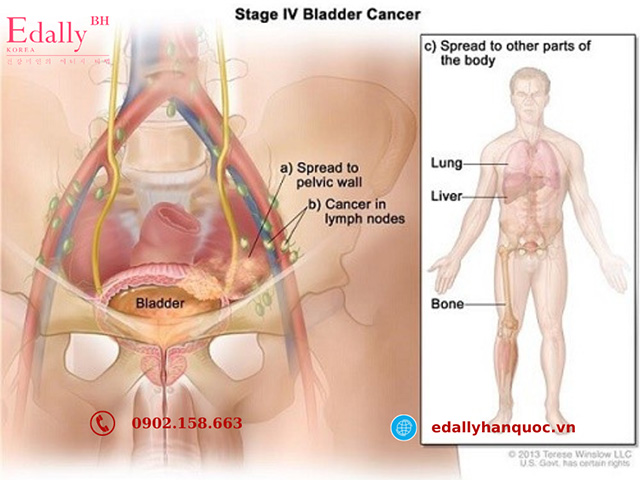 Bệnh ung thư bàng quang giai đoạn cuối