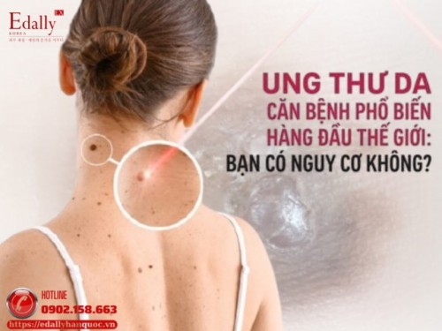 Ung Thư Da - Căn Bệnh Phổ Biến Hàng Đầu Thế Giới: Bạn Có Nằm Trong Nhóm Nguy Cơ?