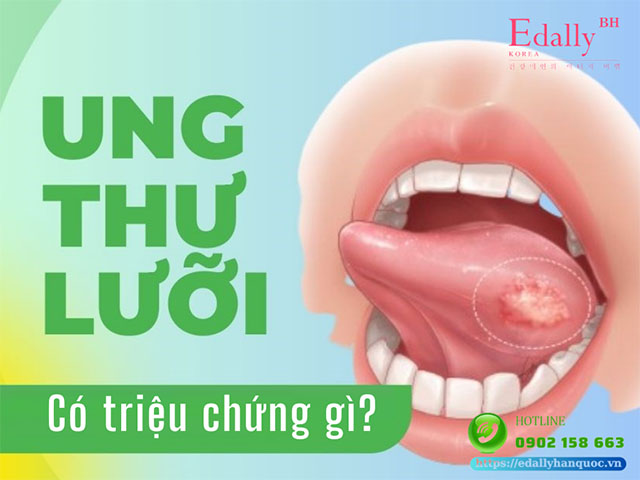 Ung thư lưỡi có triệu chứng gì?