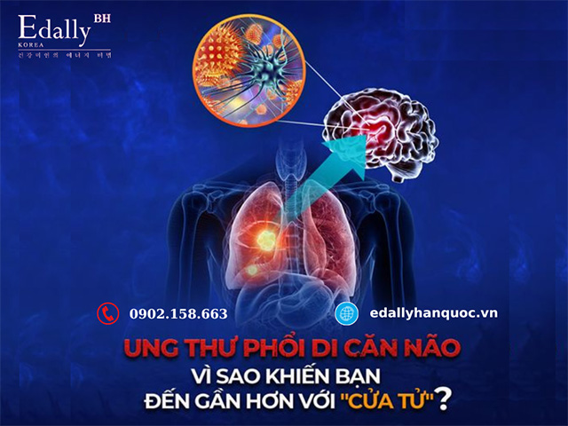 Vì sao ung thư phổi di căn lên não khiến bạn đến gần hơn với cửa tử?