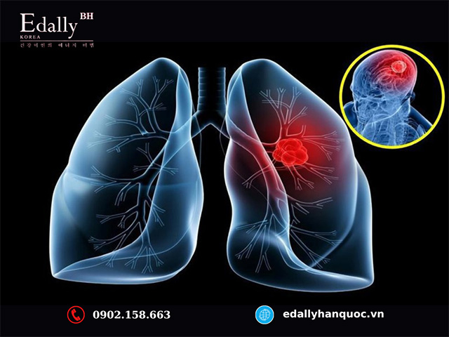 Ung thư phổi di căn lên não sống được bao lâu?