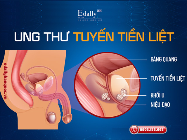 Bệnh ung thư tiền liệt tuyến thường gặp nhất ở nam giới