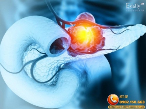 Ung Thư Tụy: Nguyên Nhân, Triệu Chứng, Chẩn Đoán Và Điều Trị