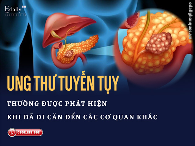 Ung thư tuyến tụy thường được phát hiện khi đã di căn sang các cơ quan khác