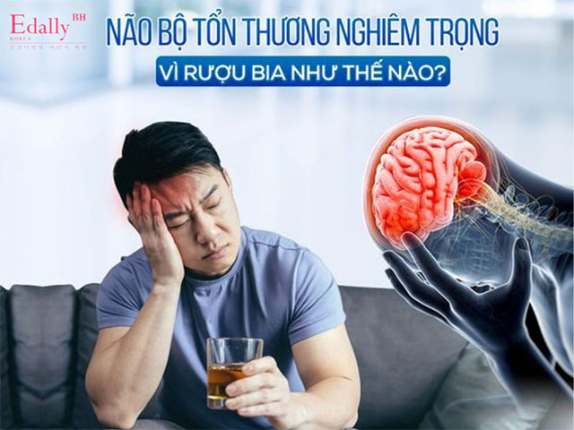 Uống nhiều rượu bia khiến cho não bộ bị tổn thương nghiêm trọng