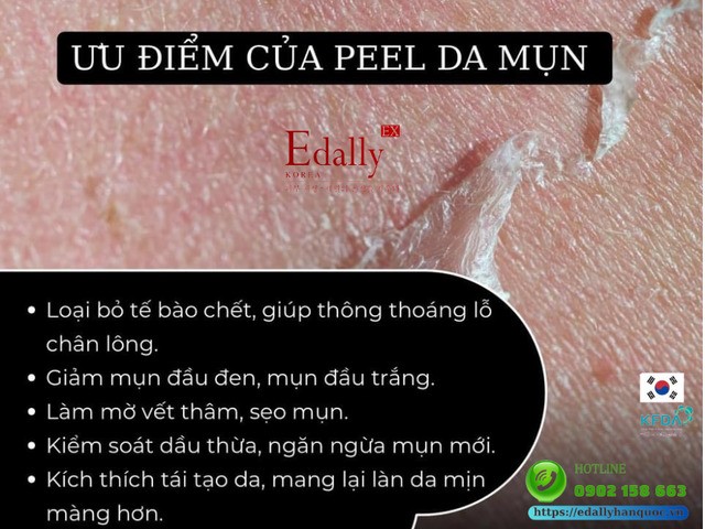 Peel da mụn có ưu điểm gì?