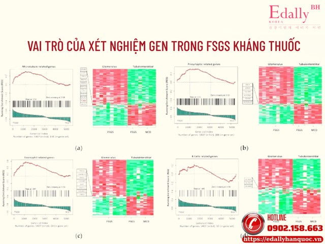 Vai trò của xét nghiệm Gen trong bệnh hội chứng thận hư do FSGS kháng thuốc