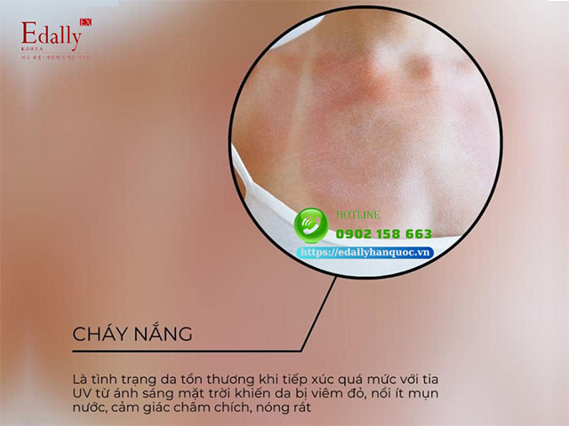 Cháy nắng - Vấn đề da thường gặp trong mùa hè nóng bức