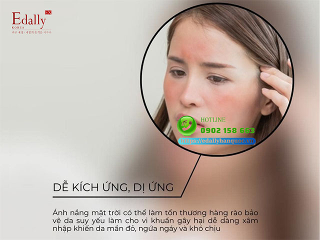 Da dễ bị dị ứng và kích ứng - Vấn đề da thường gặp trong mùa hè nóng bức