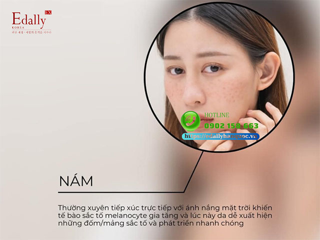 Viêm nang lông - Vấn đề da thường gặp trong mùa hè nóng bức