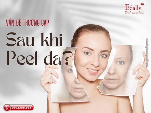 Hiện Tượng Sau Khi Peel Da Thường Gặp